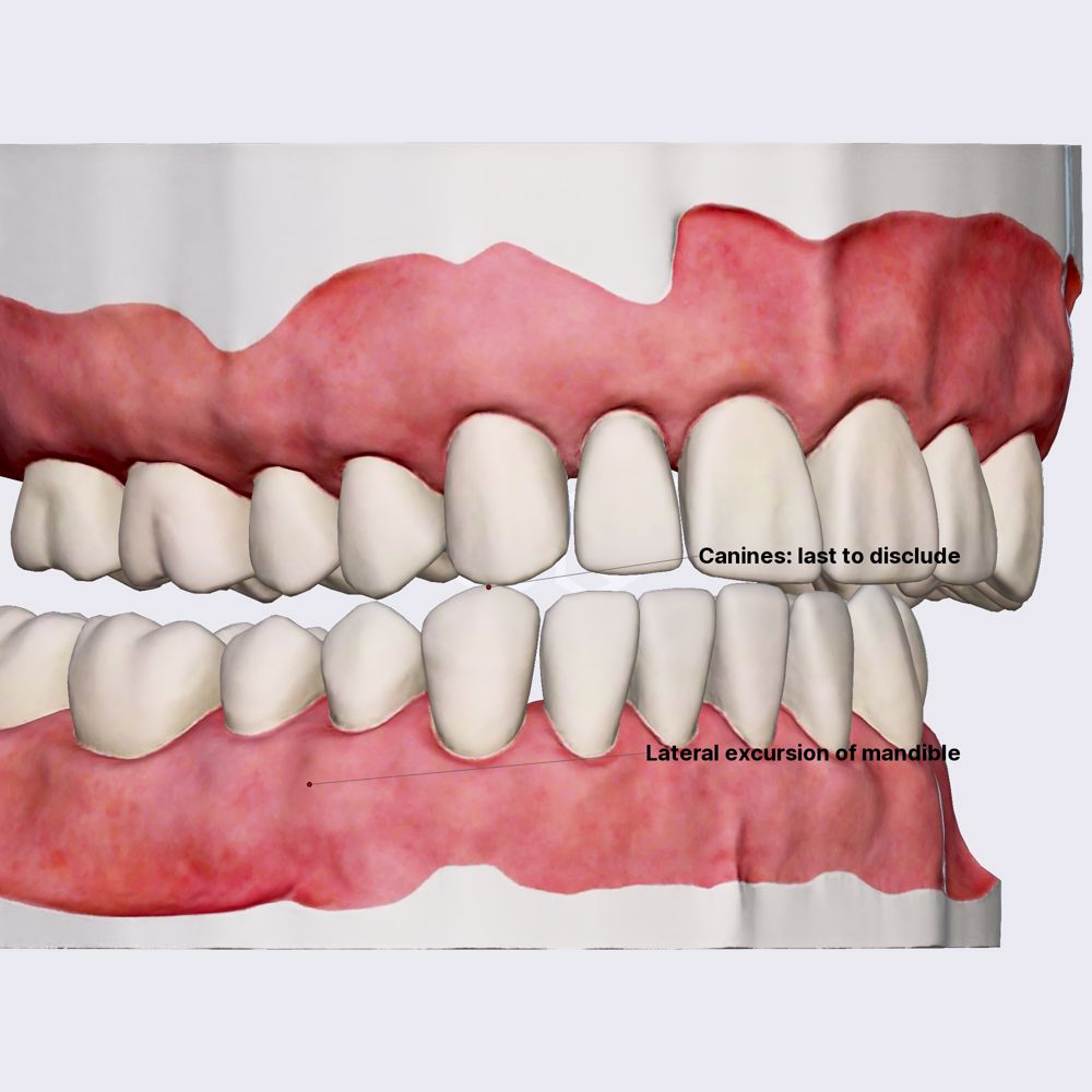 Dynamic occlusion: canine guidance
