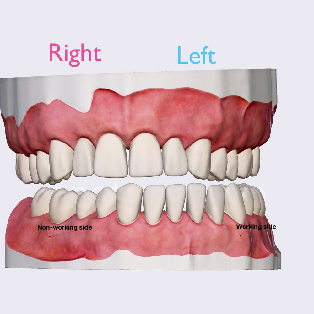 Dynamic occlusion: lateral excursion