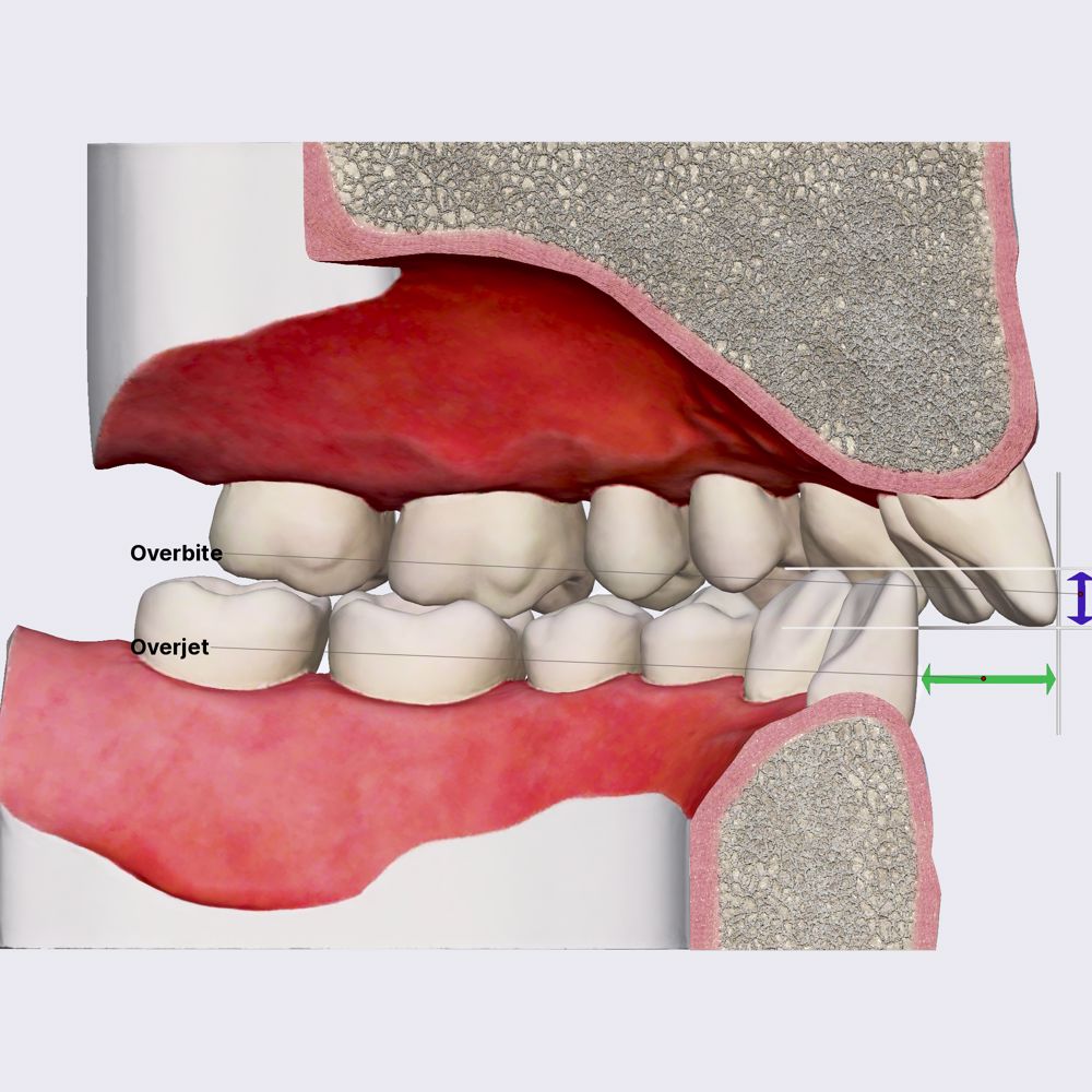 Dynamic occlussion: protrusion